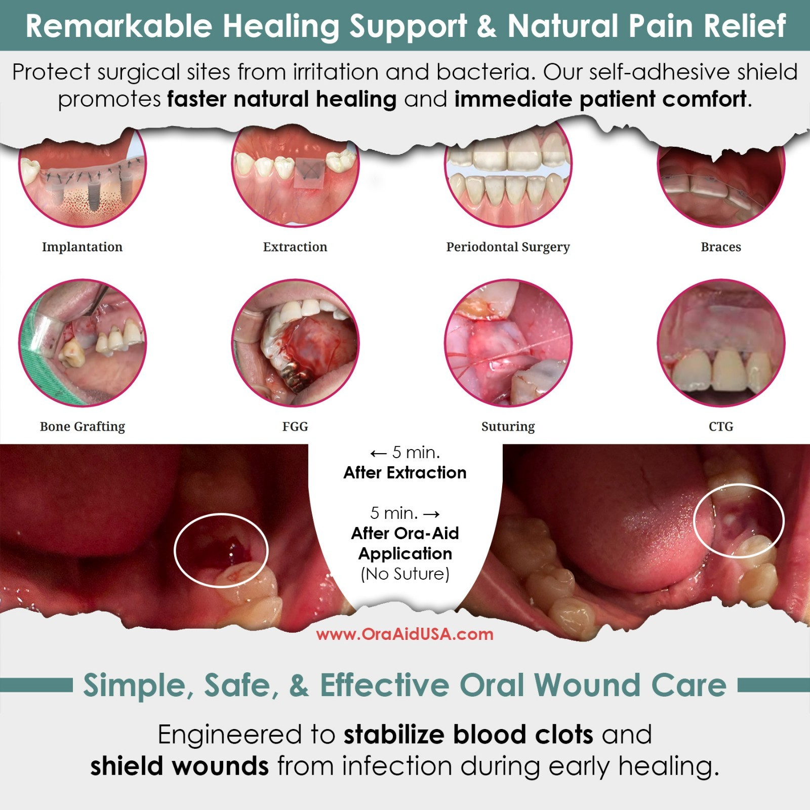 Ora-Aid 4 single-use packs | Self-Adhesive Intraoral Wound Dressing