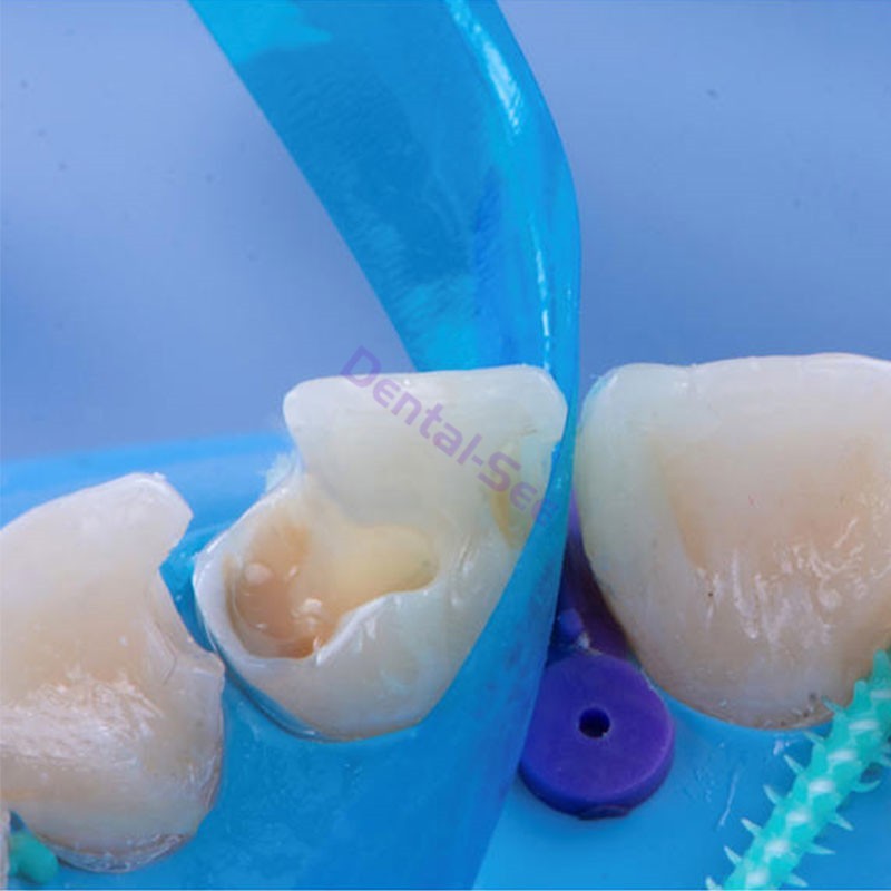 Dental Contoured Anterior Matrix Bands Teeth Restoration Strip Twin Matrices