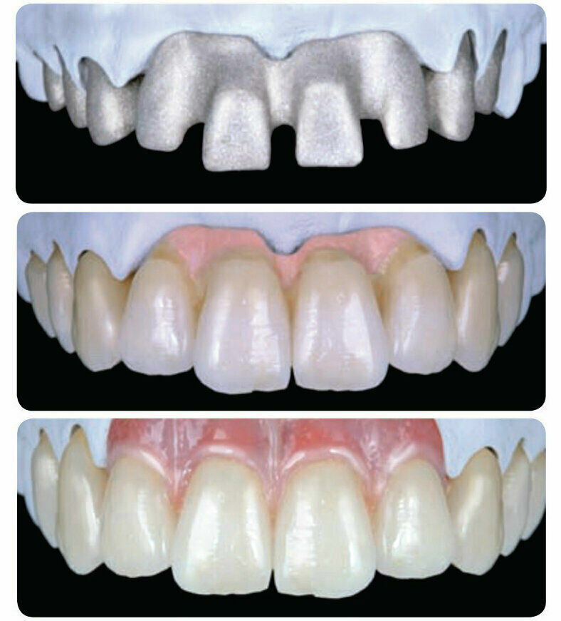 Dental Parafil composite gingiva gum shade kit LC pink tissue restoration stain