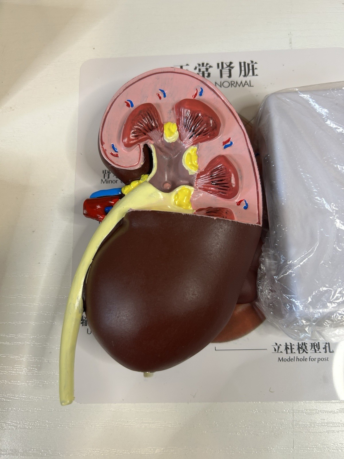 NEW Human Normal/Pathological Kidney Model Anatomy Medical Teaching Model