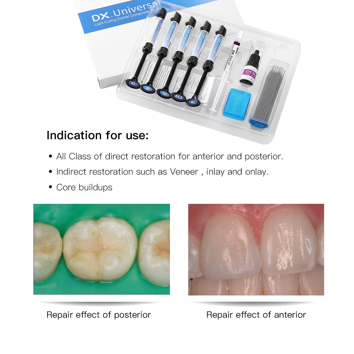 Dental Light Cure omposite Kit 5 Colors A1-A3.5 with Ethant & Bonding Agent