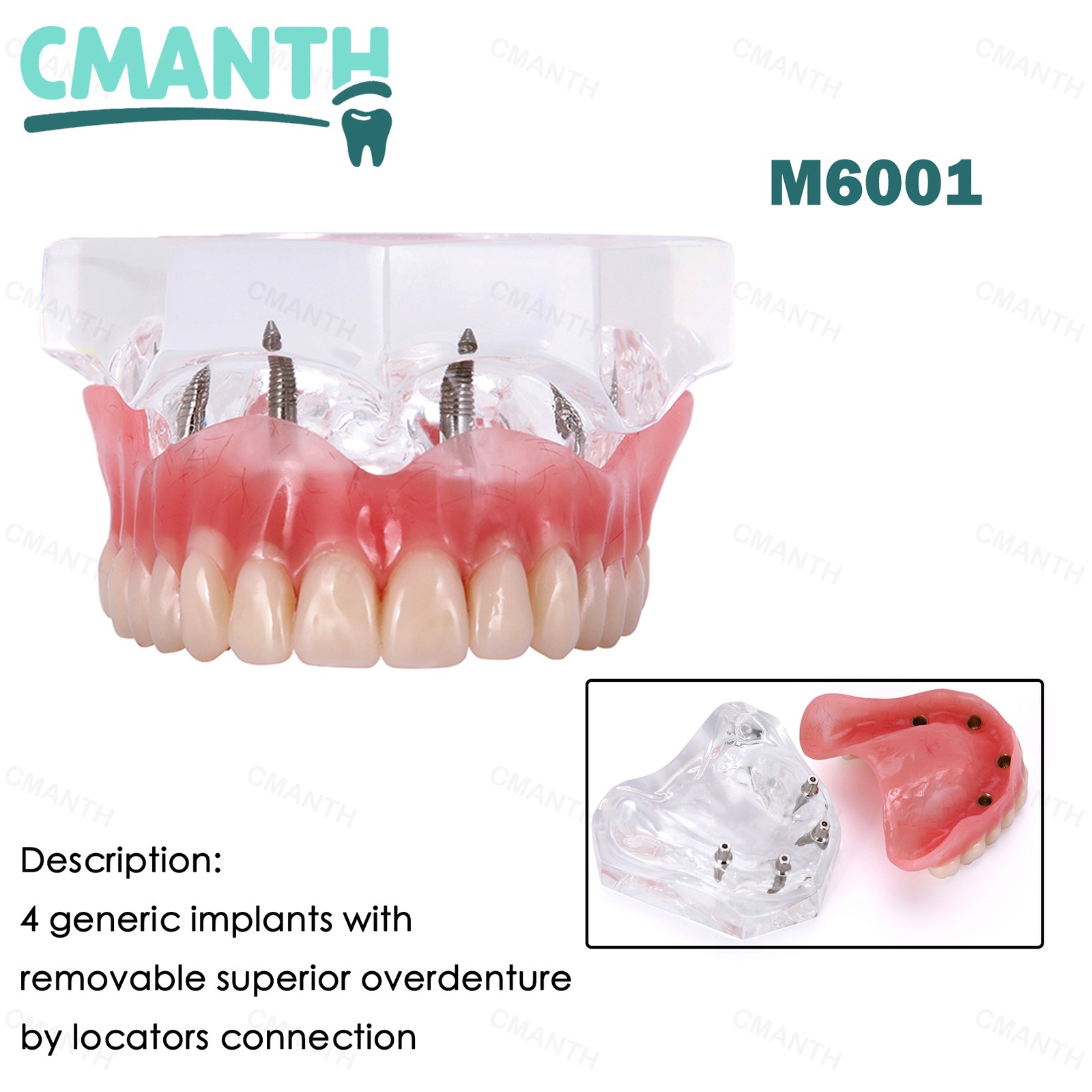 Dental Teeth Model Upper Lower Tooth 4 Implants Restoration Overdenture Model