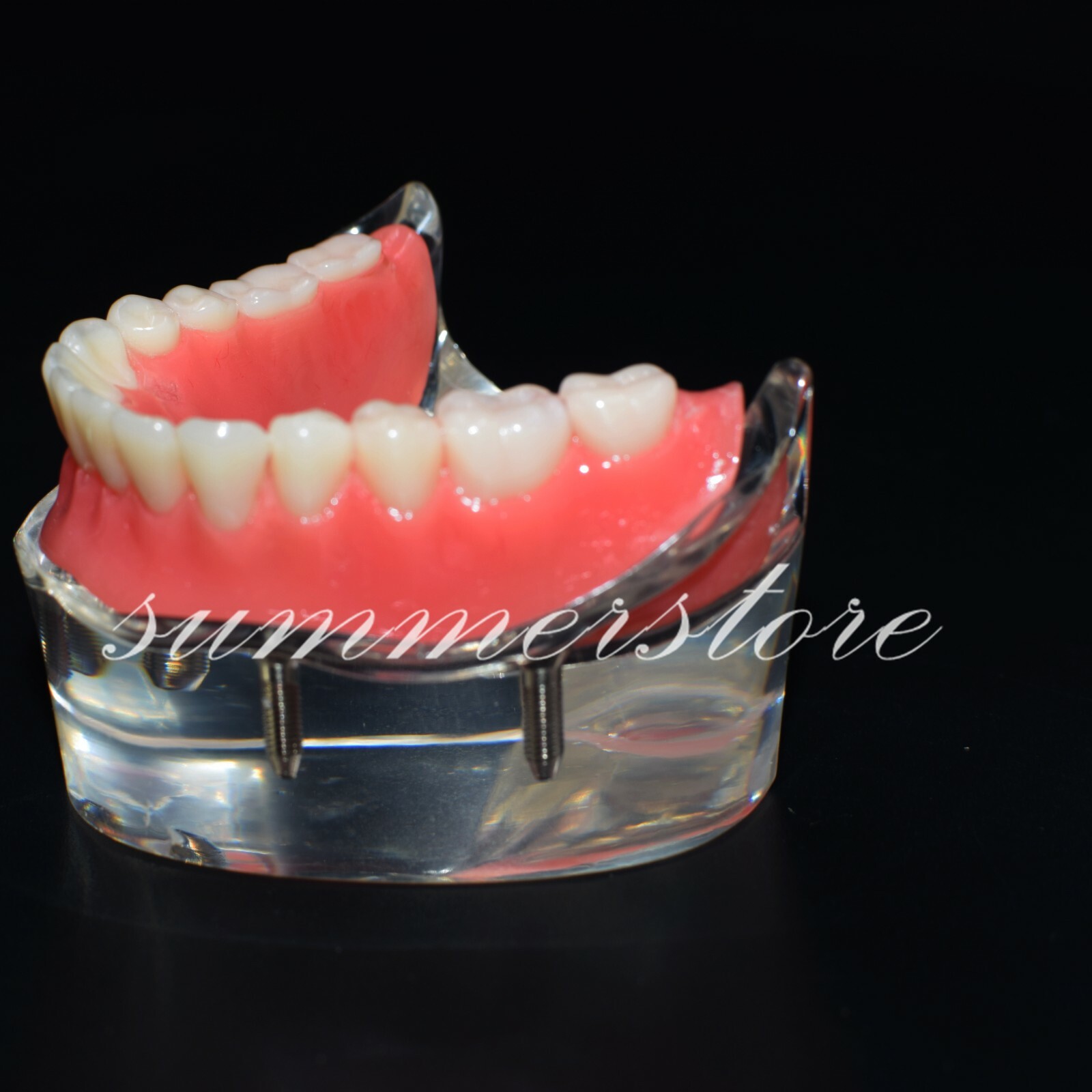 1 Pc Transparent Dental Study Demo 4 Implants Overdenture Inferior Model #6003