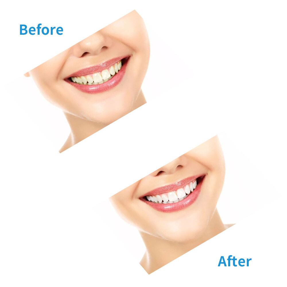10-1Pc Dental Gingival Gel Dam Barrier Gum Protector Syringe Teeth Whitening 3ml