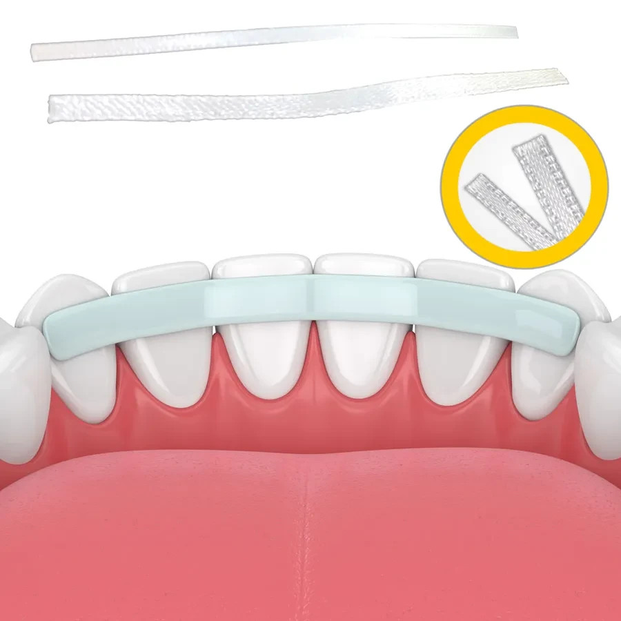 Kids-e-Dental E-Splint Esthetic fiber-reinforced splint 2MM Free Shipping