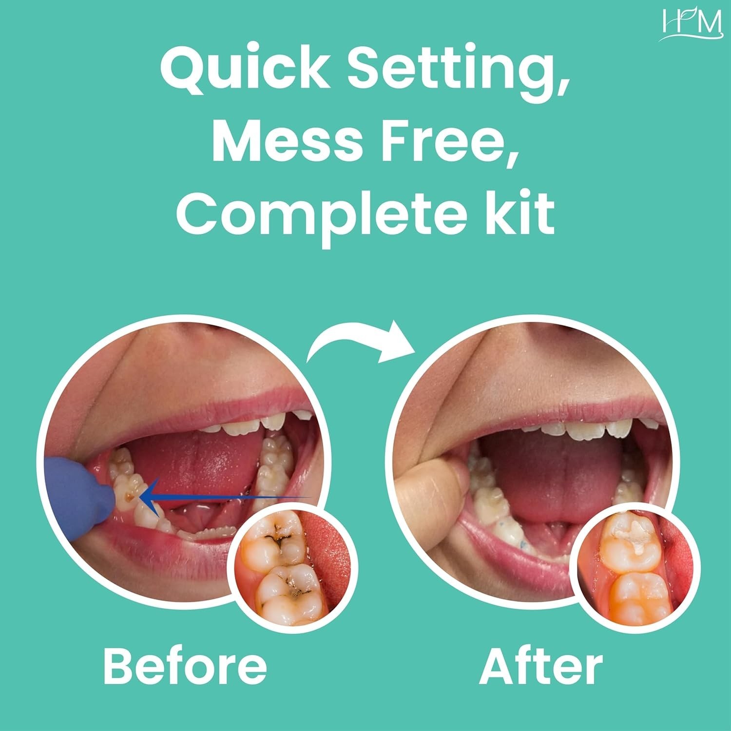 Super Adhesive Dental Cement Kit – Fast Drying, Non-Toxic Tooth Repair Solution