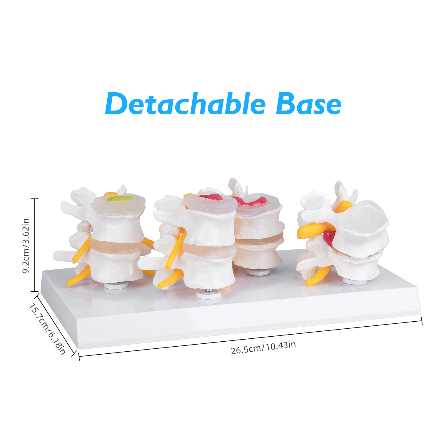 Pathological Human Lumbar Spine Anatomy Model 4-Stage Medical Science Teaching