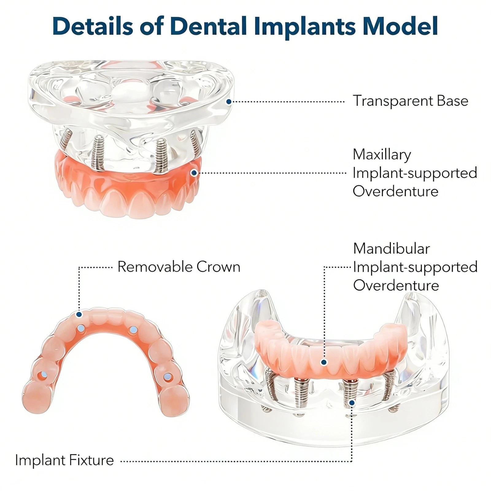 US Dental Overdenture All-on-4/6 Upper/Lower Jaw Teeth Model with 4/6 Screws