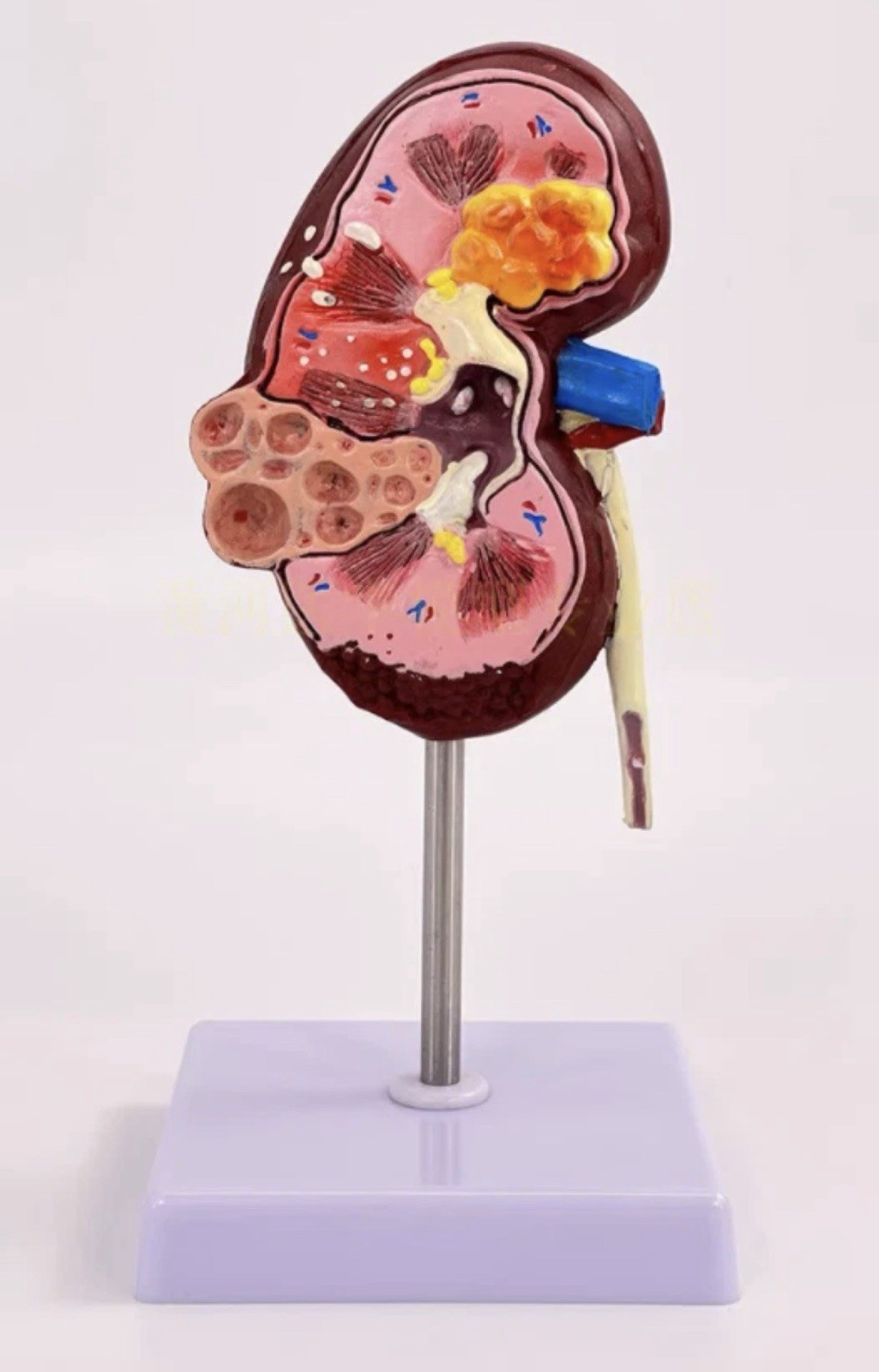 NEW Human Normal/Pathological Kidney Model Anatomy Medical Teaching Model