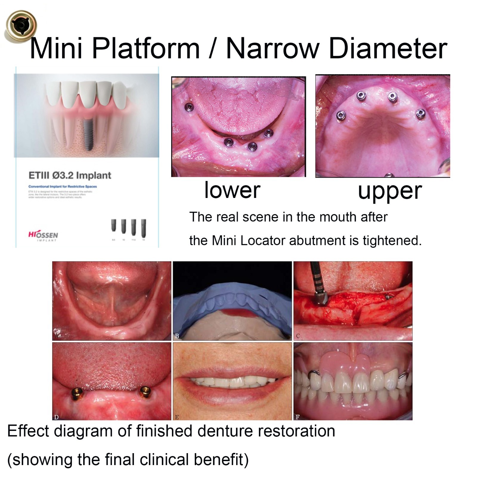 US Mini Platform ZEST Locator Legacy Abutment For Hiossen ET Implant Overdenture