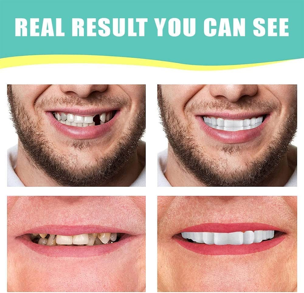 1Set Dentures Veneers Tooth,Dental Care Kits for 1 Count (Pack of 1), white