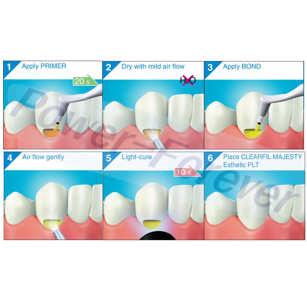 Kuraray Dental ClearFIL SE/S3 BOND Light-Curing Selfetching Primer Bond Adhesive