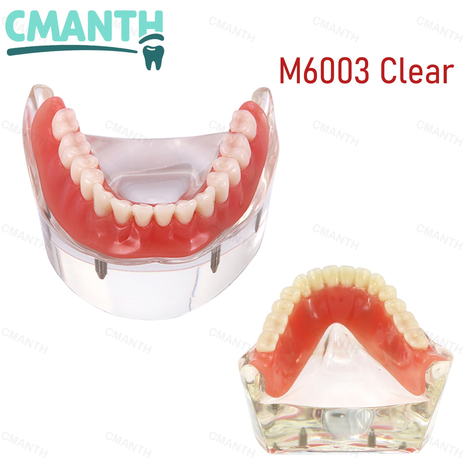 Dental Teeth Model Upper Lower Tooth 4 Implants Restoration Overdenture Model