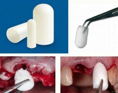 50 Pack of Colo Plug – Resorbable Collagen Plug (Pure Collagen Sponge) 8x20mm