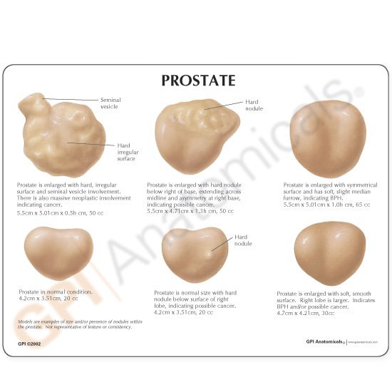 Prostate GPI Anatomical Model Set BPH Card LFA #3000.Make Us an Offer! SEE VIDEO