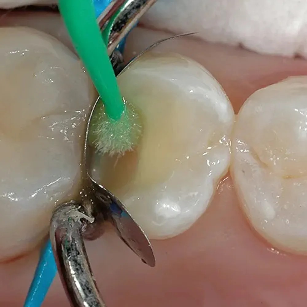 7th generation self-etching bonding agent for dentin and enamel surface