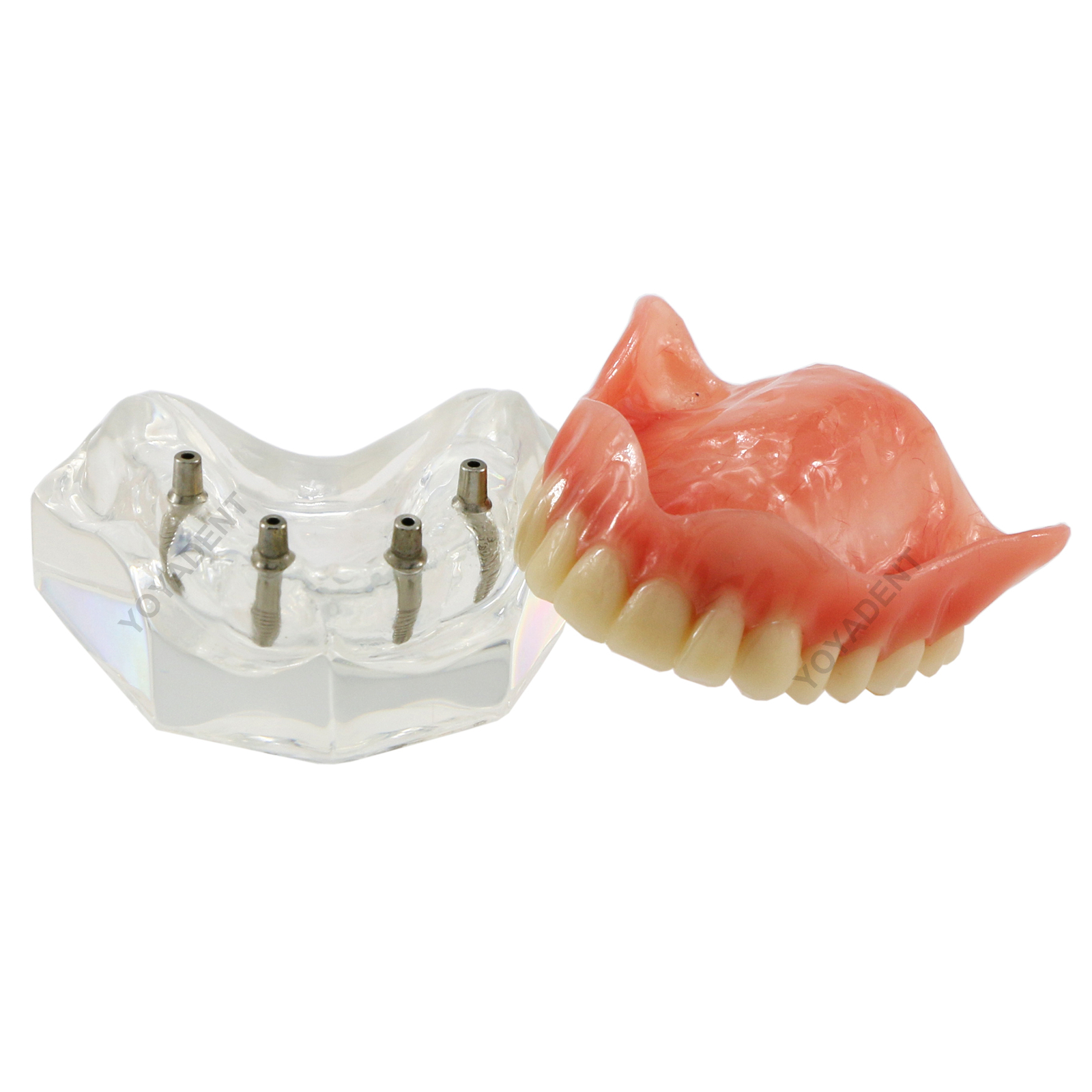 US Dental Teeth Model Ortho Implant Practice Teaching With Implants Demo Model