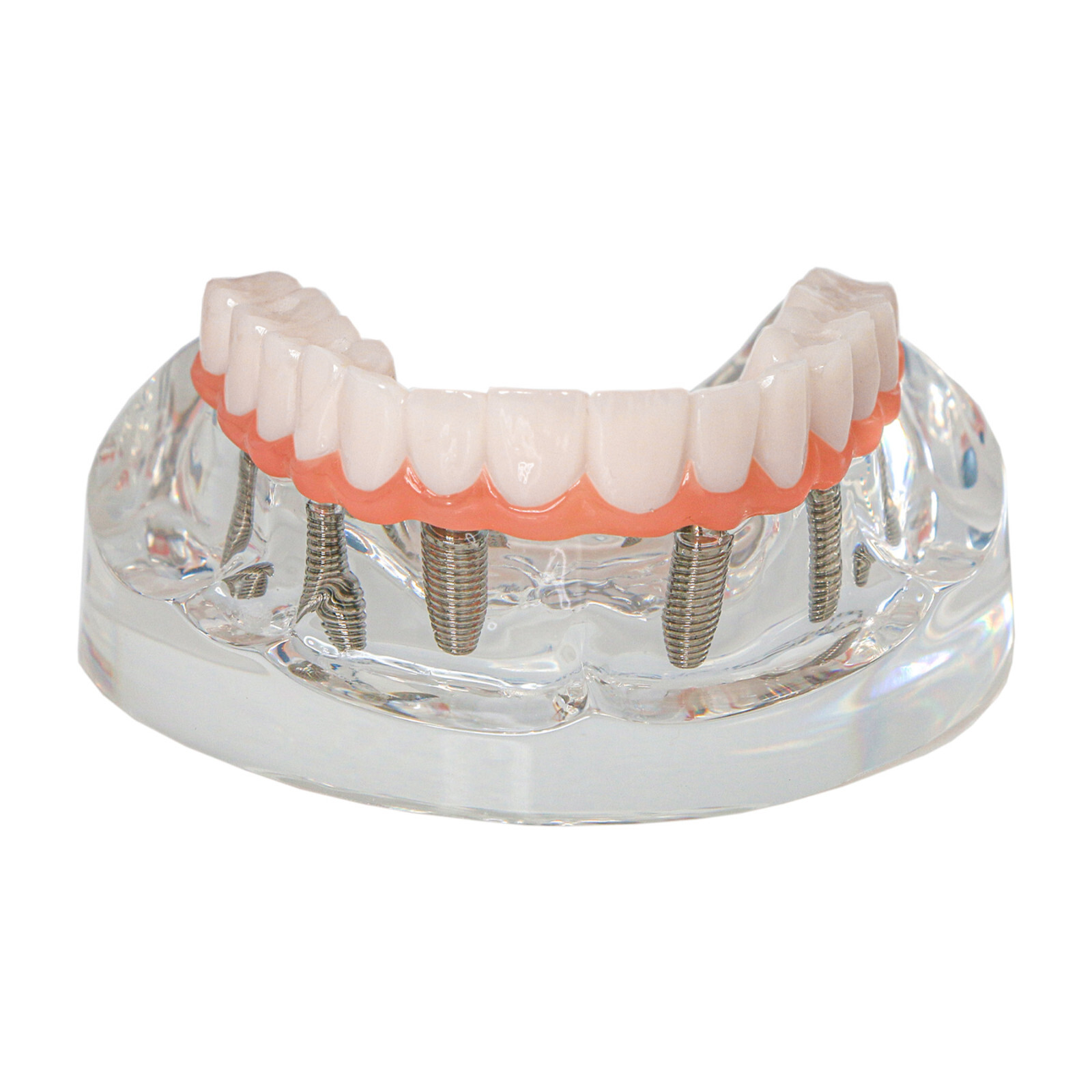 Dental All-On-6 Overdenture Implant Model Demo Upper Jaw 6 Screws Clear M6001-2
