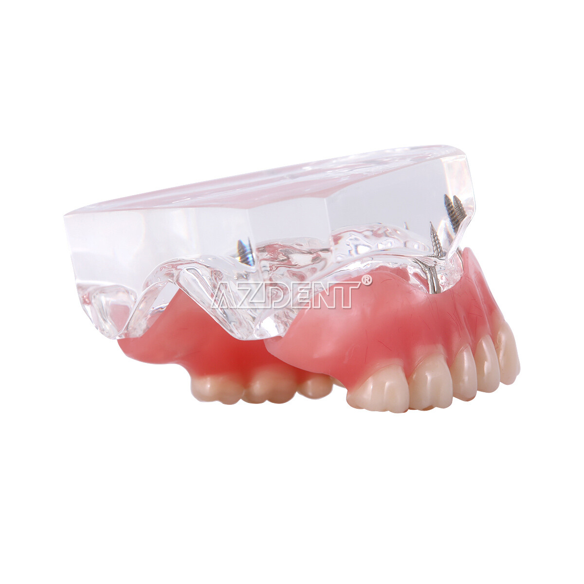 Implante dental Dientes Modelo Demo Sobredentadura Restauración 2/4 Implantes