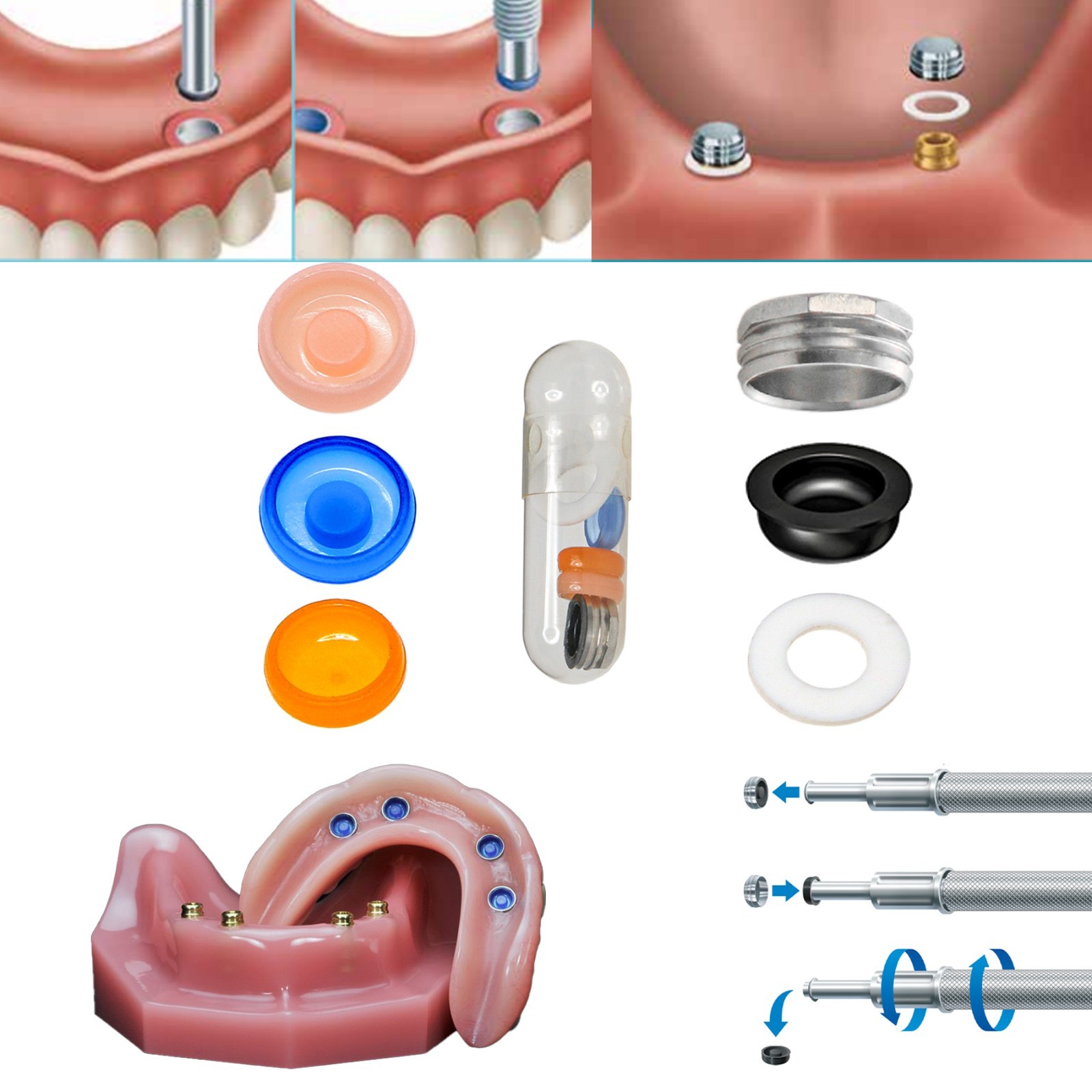 US Dental Locator Abutment Overdenture Retention Male Caps Inserts Metal Housing
