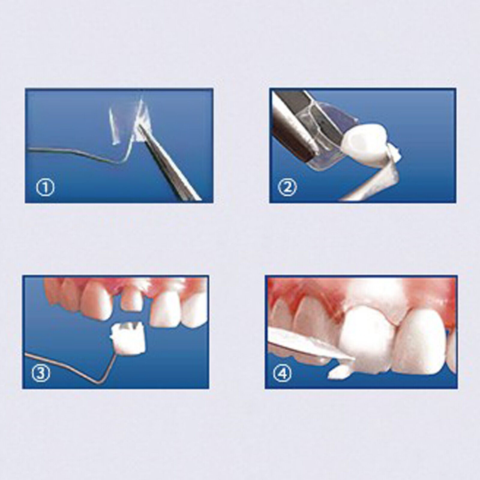64Pcs Dental Anterior Transparent Crowns Deciduous For Adult/Kids Matrix Veneers