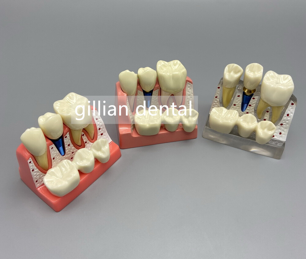 Dental Model Teeth Implant Restoration Bridge Teaching Study Medical Science