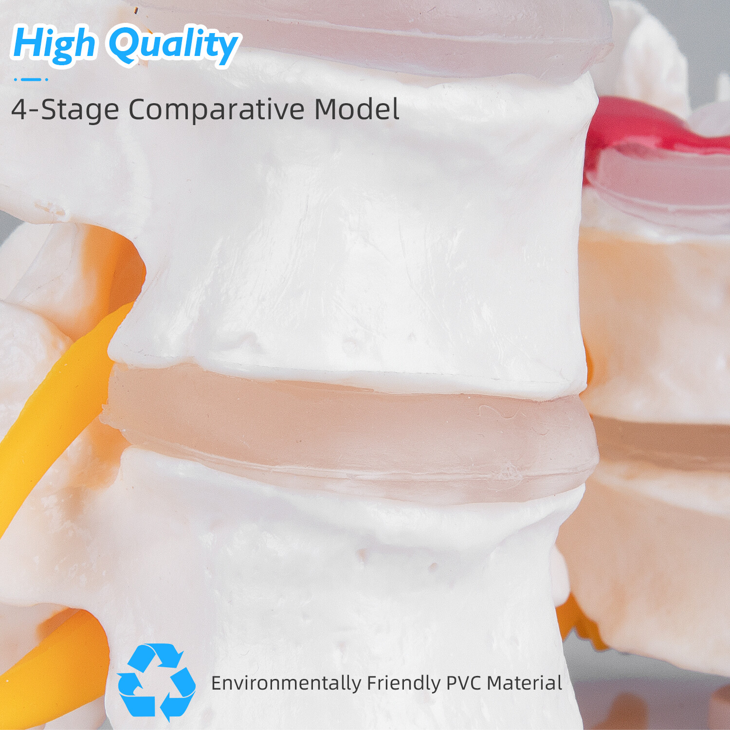 Pathological Human Lumbar Spine Anatomy Model 4-Stage Medical Science Teaching