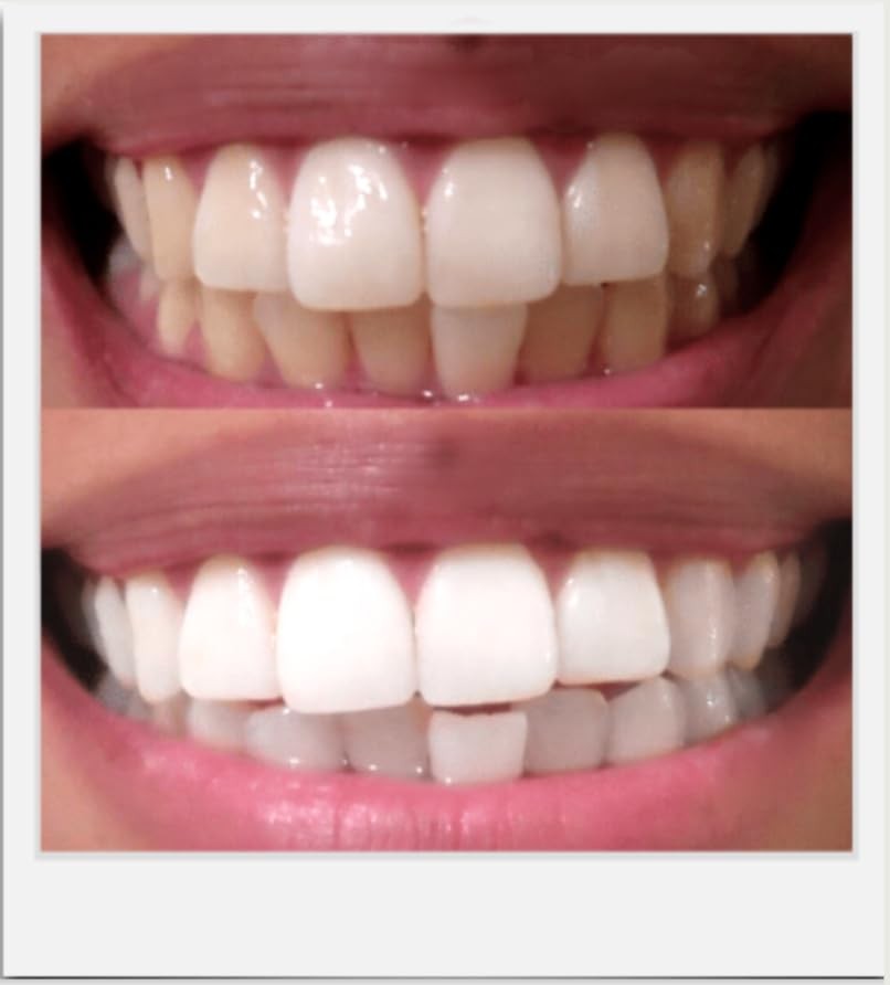 Expertwhite Teeth Whitening Gel Refills (6-gels). Made 0.1 Fl Oz (Pack of 6)