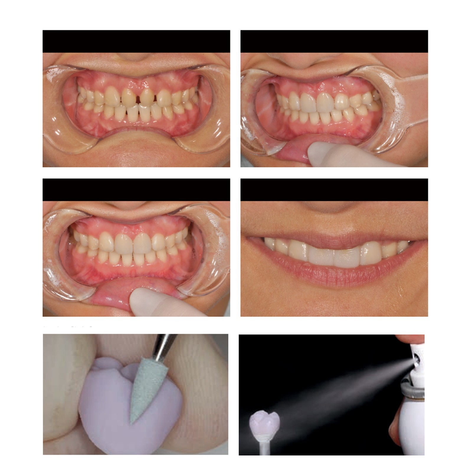 Dental Emax Lithium Disilicate Blocks C14 CAD/CAM CEREC Inlab Chairside System