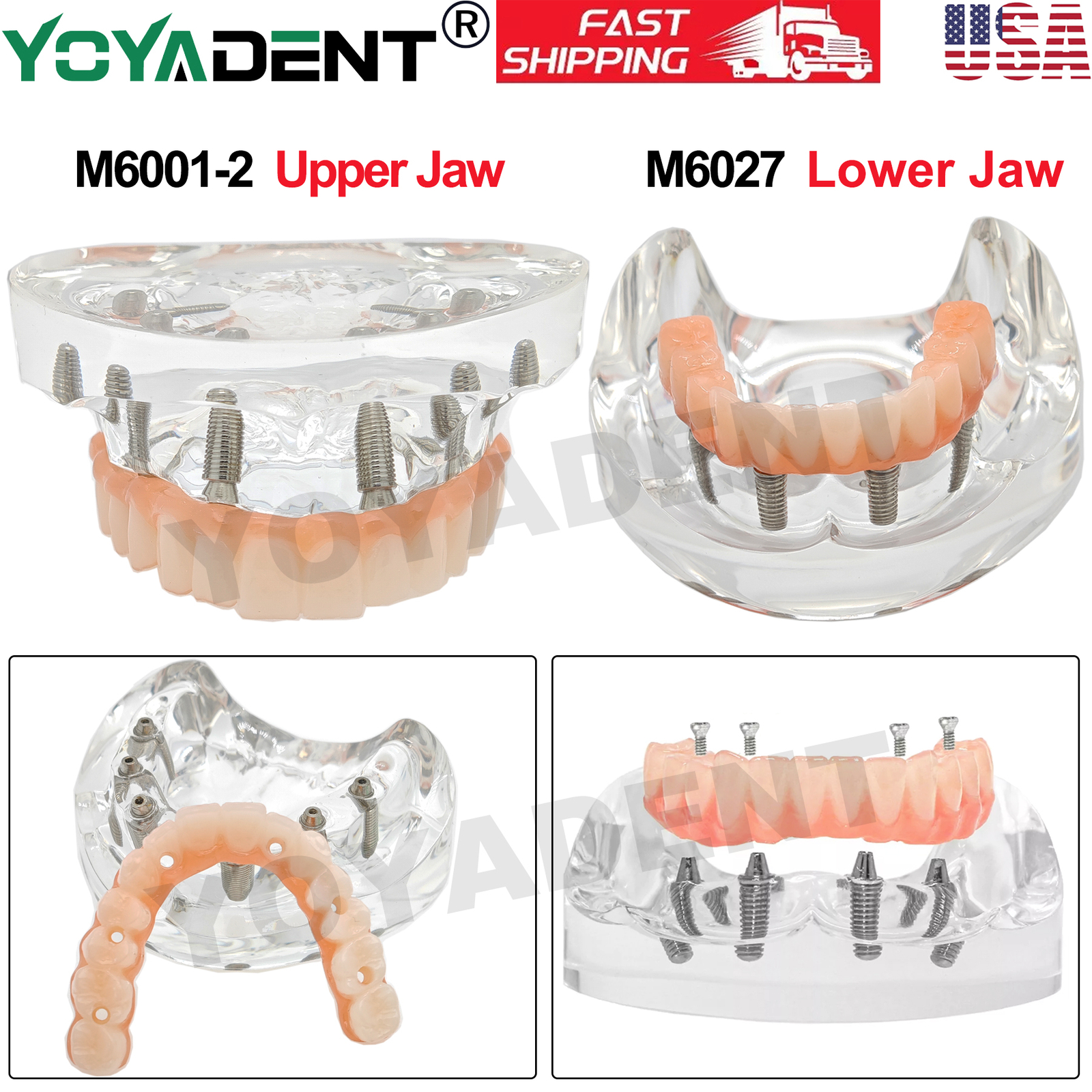 US Dental Teeth Model Overdenture Inferior Implants Demo Upper/Lower Detachable