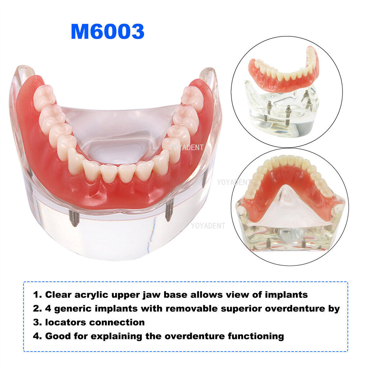Dental Teeth Model Removable Overdenture Teeth Upper/Lower Jaw 4 Implants Model