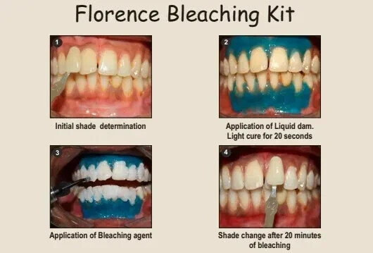 Prevest Florence Teeth Whitening Kit- 1 Patient