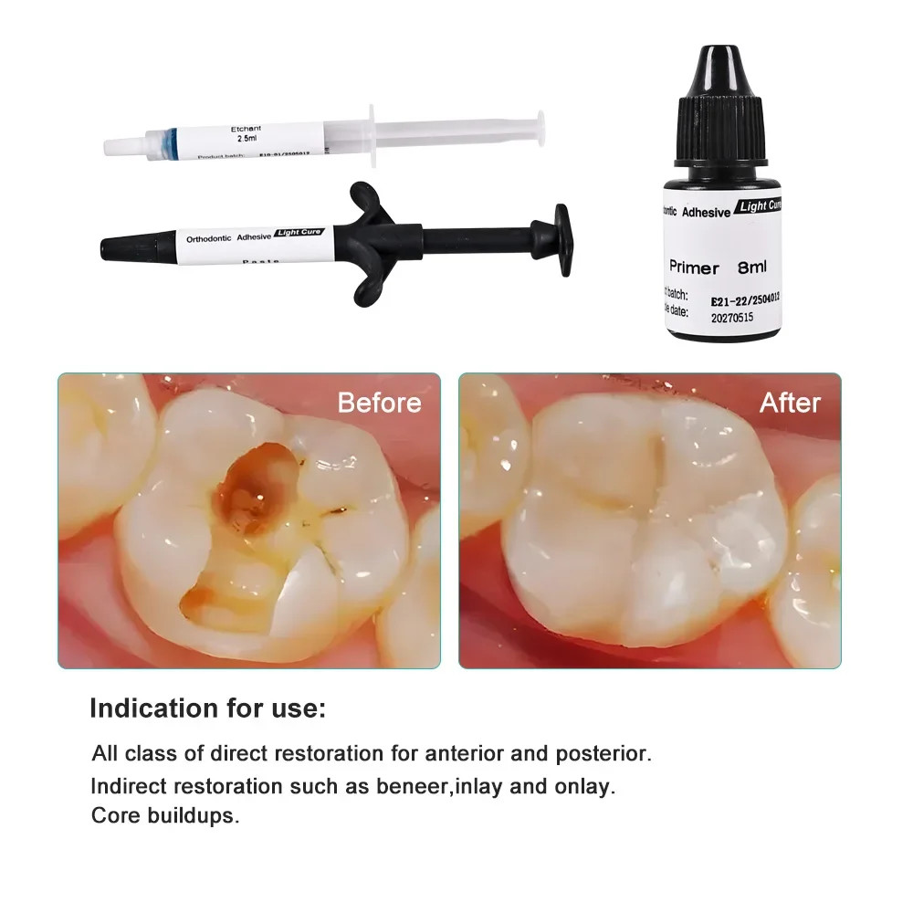 Dental Orthodontic Adhesive Kit Light Curing Direct Bonding System Bracket Brace