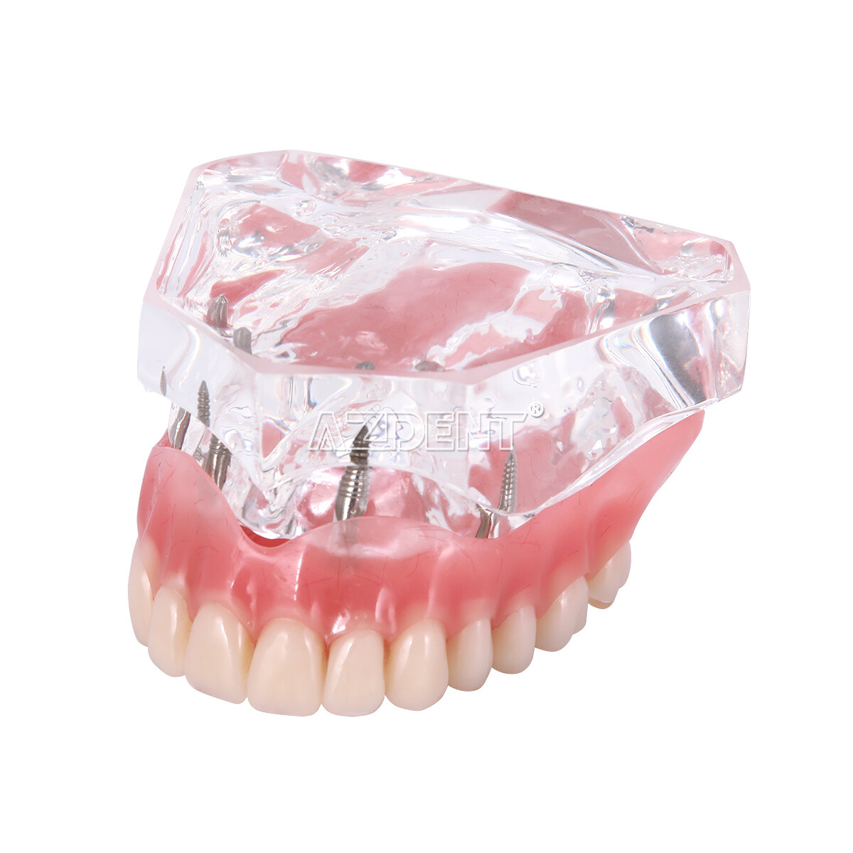Implante dental Dientes Modelo Demo Sobredentadura Restauración 2/4 Implantes