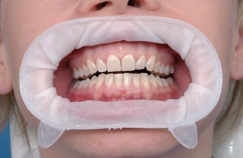 Ivoclar OPTRAGATE 3D Mouth Opener Cheek & Lip Retractor PACKS & SIZES AVAILBLE