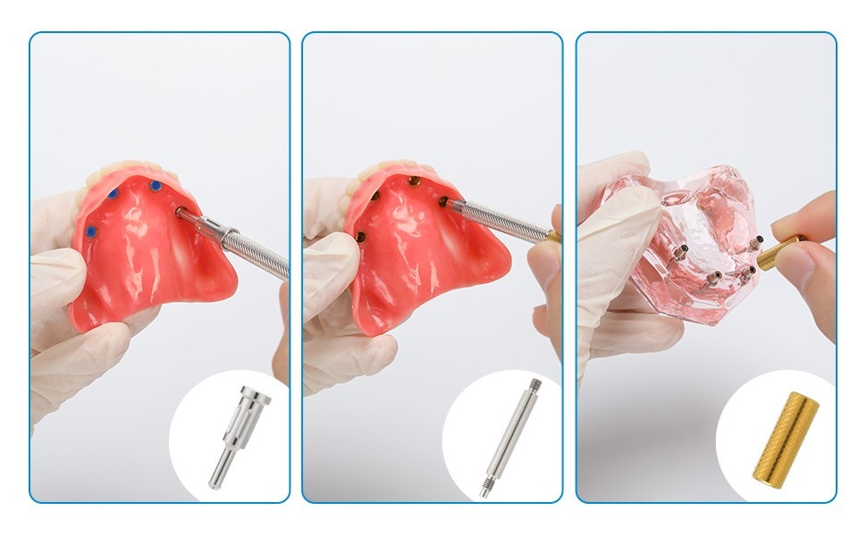 US Dental Locator Abutment Overdenture Retention Male Caps Inserts Metal Housing