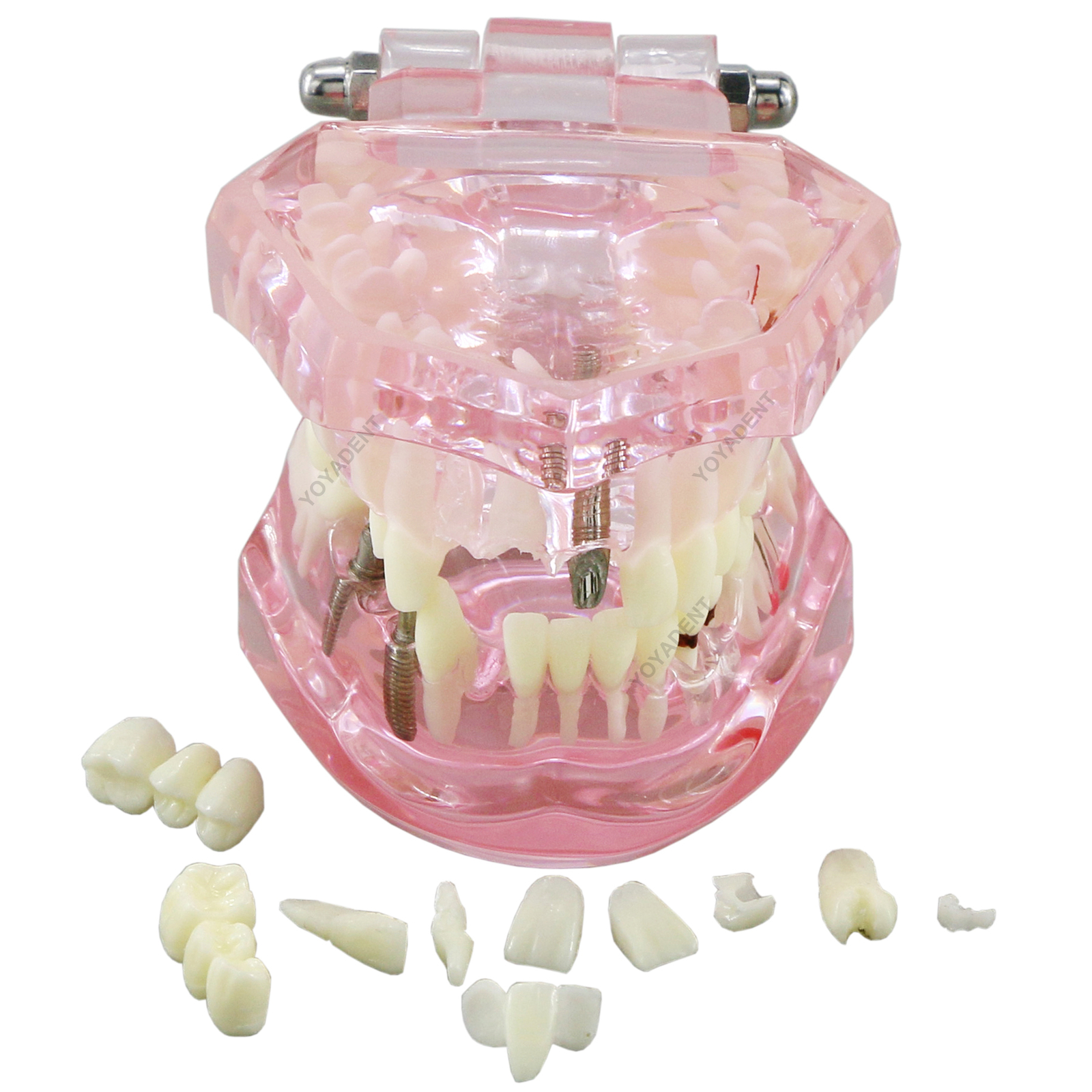 US Dental Teeth Model Ortho Implant Practice Teaching With Implants Demo Model