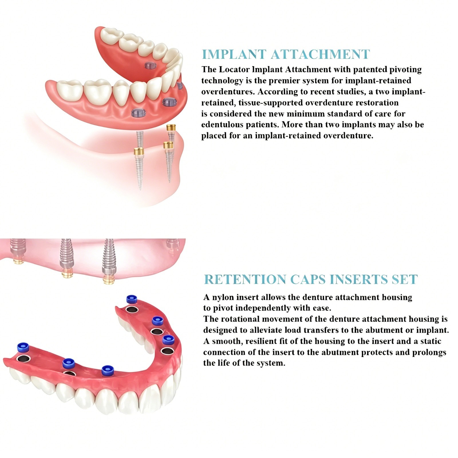 US Dental Locator Abutment For BioHorizons/Hiossen/Nobel/Zimmer Multiple Implant