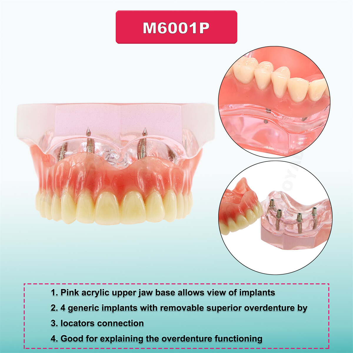 US Dental Teeth Model Overdenture Inferior Implants Demo Upper/Lower Detachable