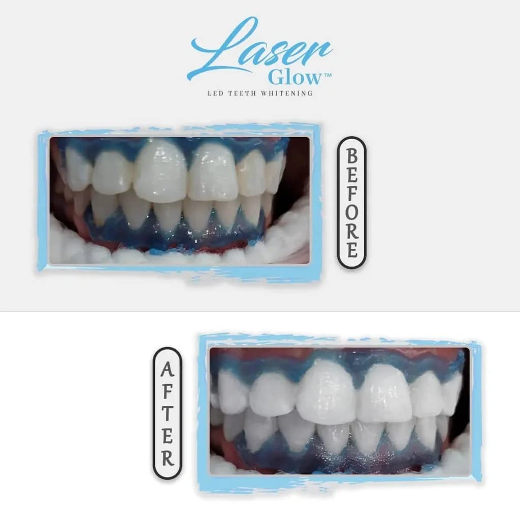 LaserGlow Professional Teeth Whitening Gel 44% Hydrogen 1 Fl Oz (Pack of 1)
