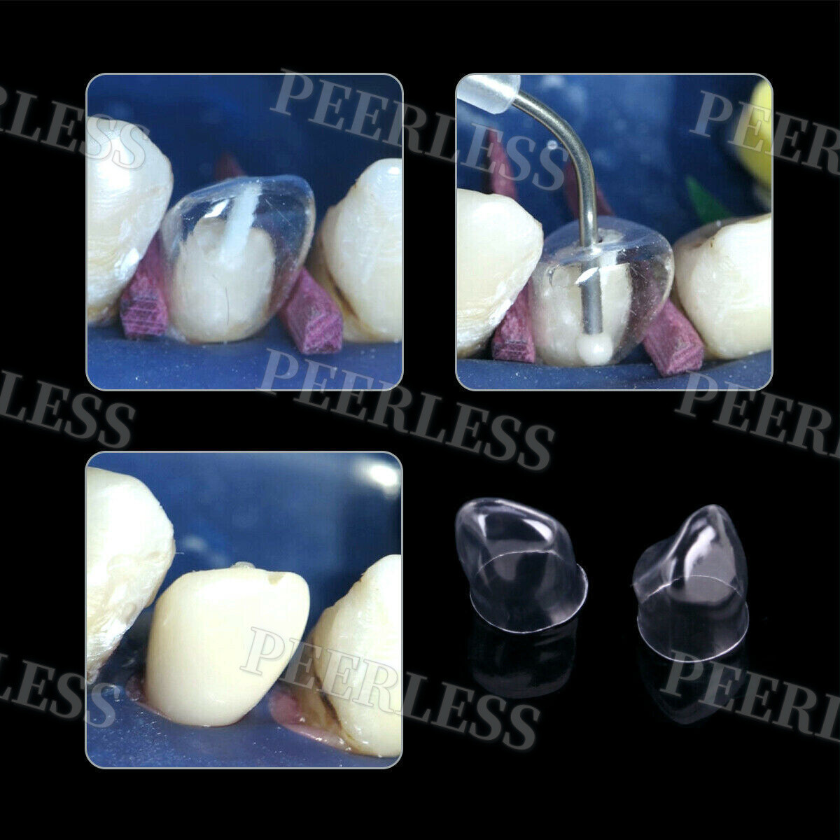 No.1.910 Dental Anterior Transparent Forms For Temporary Crowns Kit TOR VM 64Pcs