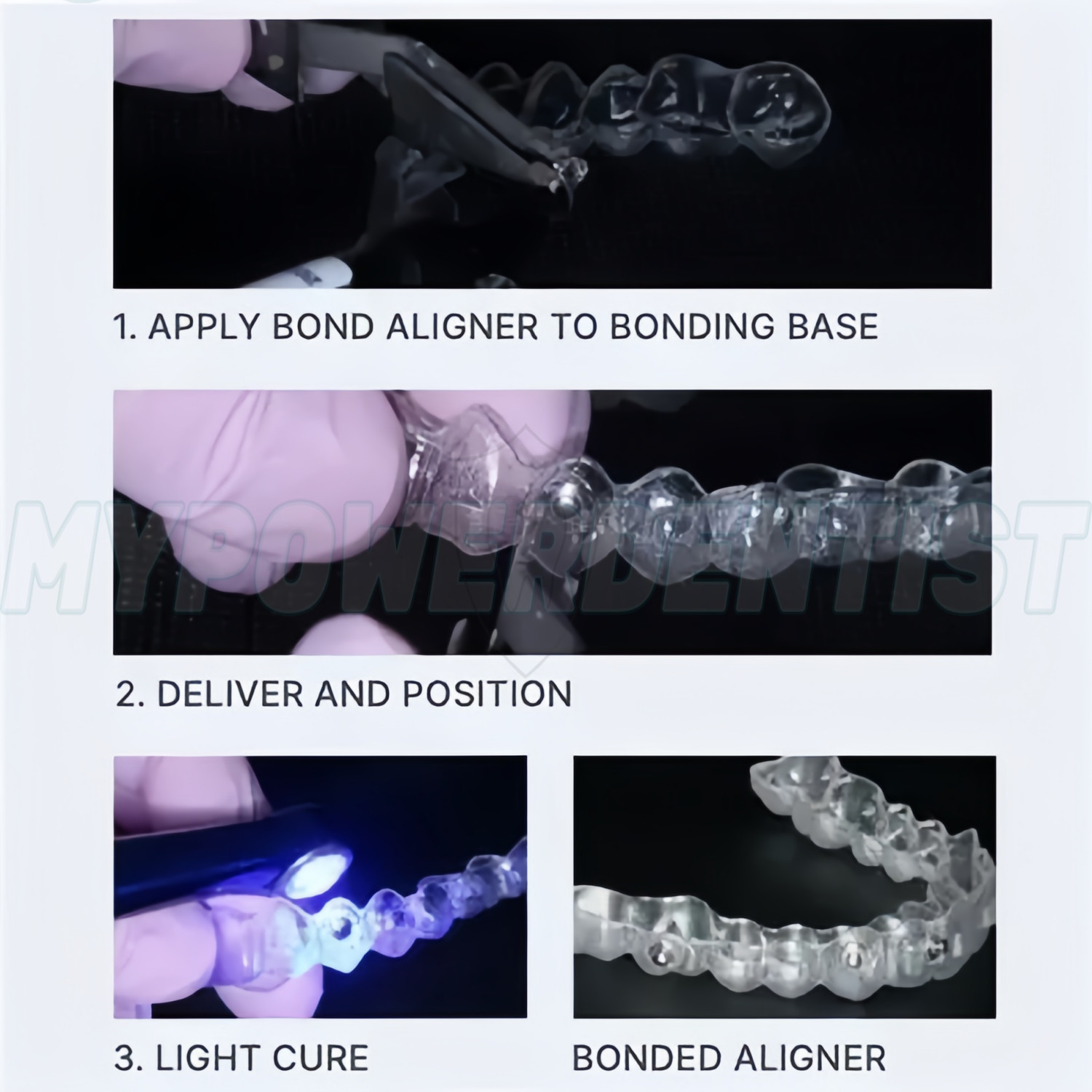 Dental Light Cure Orthodontic Adhesive Paste for Aligner Attachments 2.5g Kit