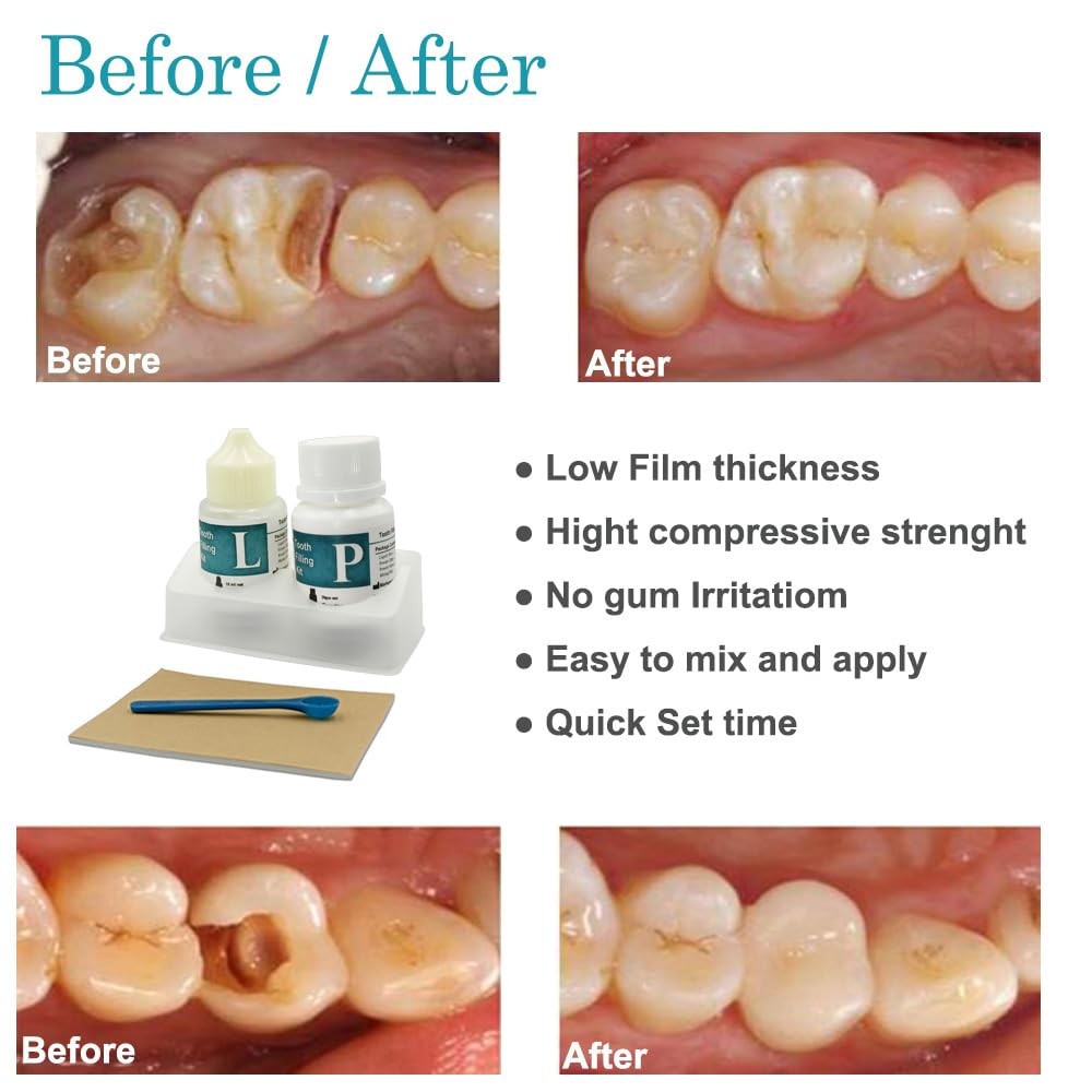 Zinc Oxide Eugenol Dental Cement Kit | Super Adhesive | Instant Tooth Repair, Ca