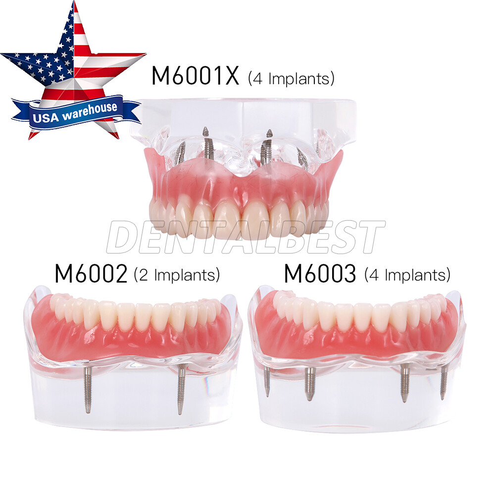 Dental Implant Teeth Model Demo Overdenture Restoration 2 / 4 Implants Upper Low