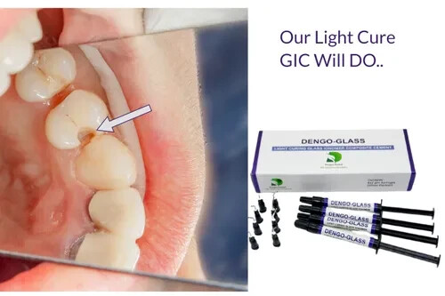 Dental DENGO-GLASS Light Curing GIC Composite Cement 4 x 2g Pack