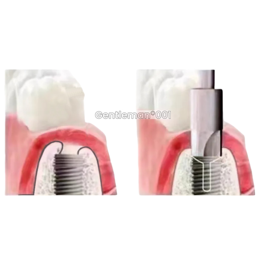 Dental Countersink Drill Smooth Ridge Trimmer Drills Abutment Bone Remove