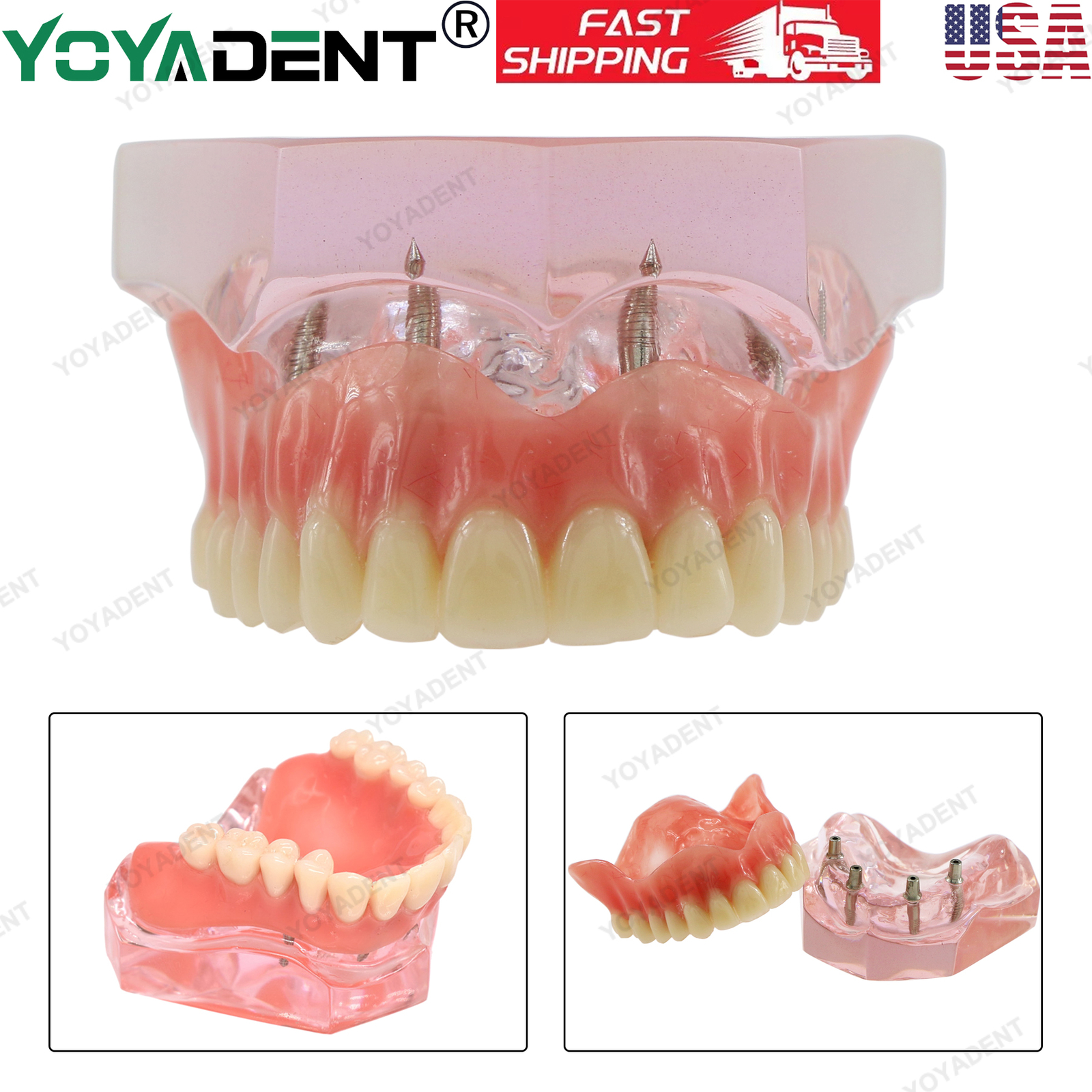 US Dental Teeth Model Ortho Implant Practice Teaching With Implants Demo Model