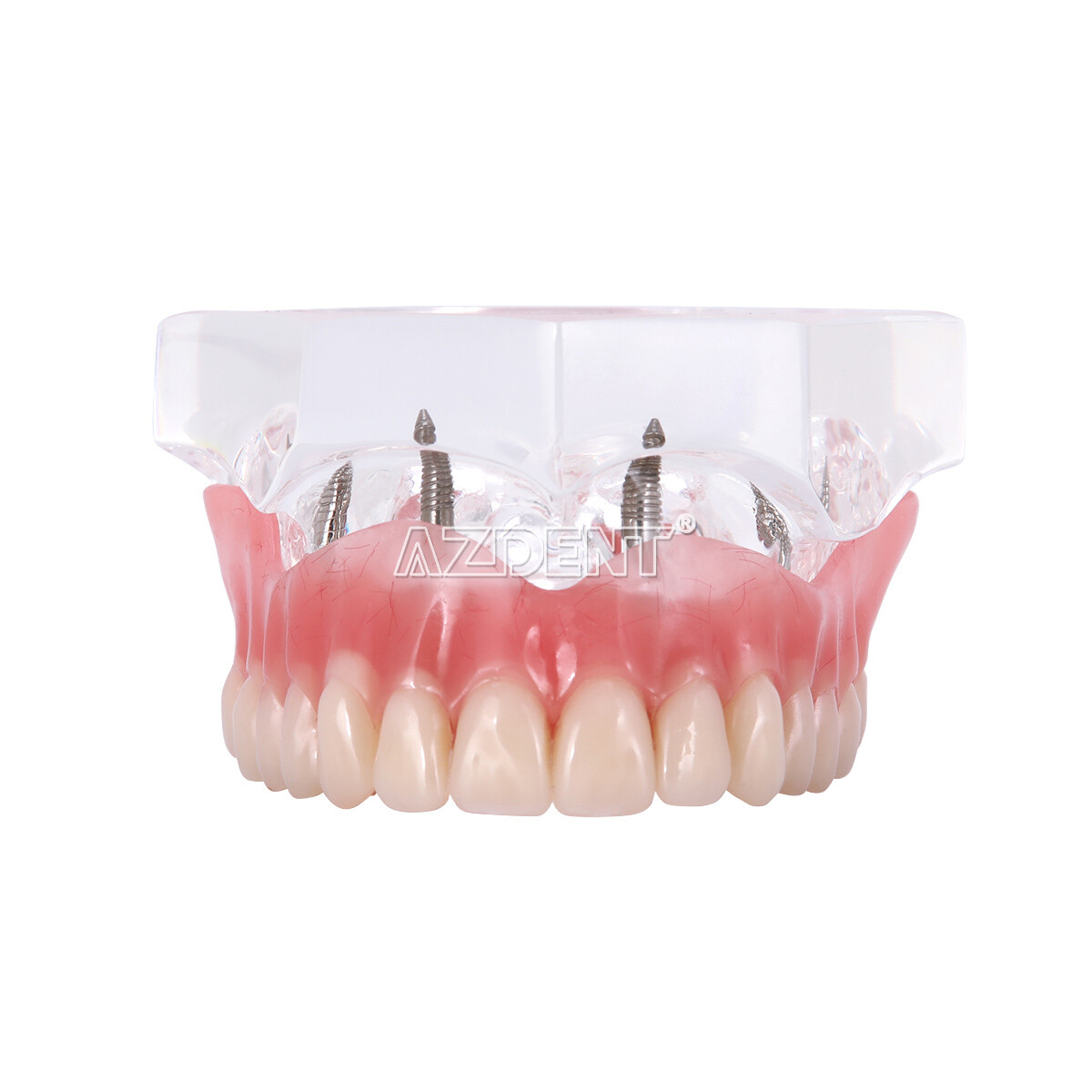 Implante dental Dientes Modelo Demo Sobredentadura Restauración 2/4 Implantes