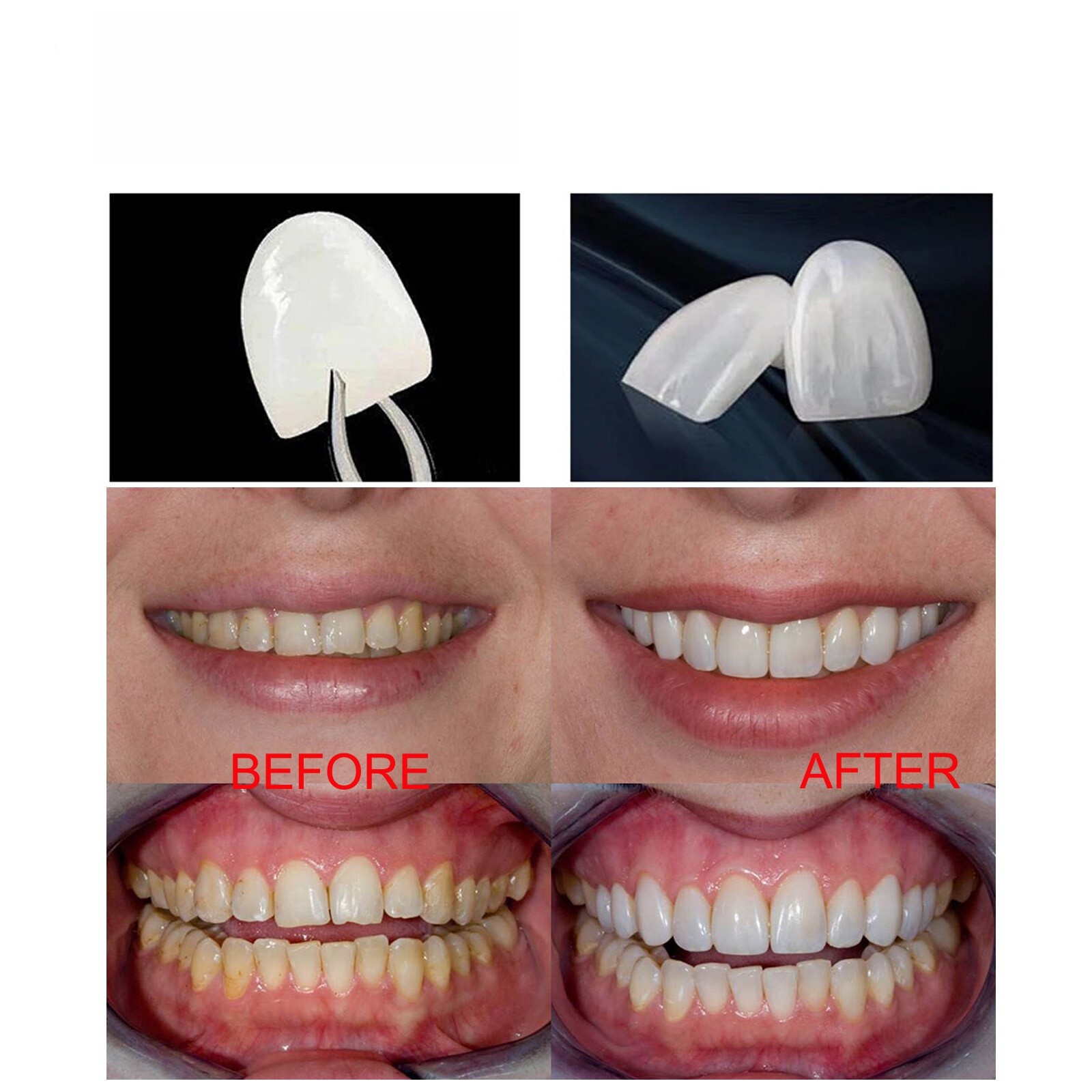 30Size Dental Composite Porcelain Veneers Resin Light Cure Anterior Teeth Veneer