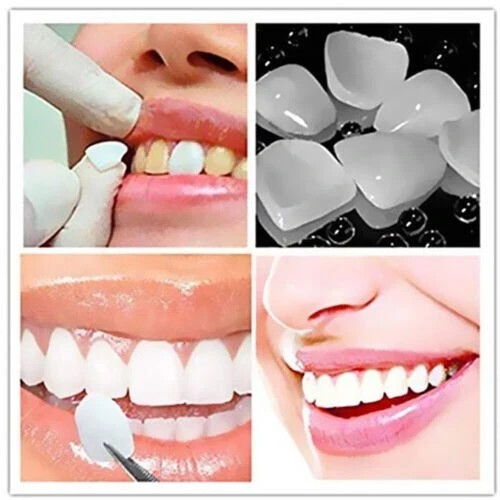 Dental 50PCS Temporary Crown Veneers for Anterior Front Teeth Whitening Resin US